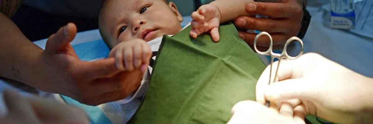 Plastibell Circumcision: A Modern, Safe, and Hygienic Method for Infant Circumcision